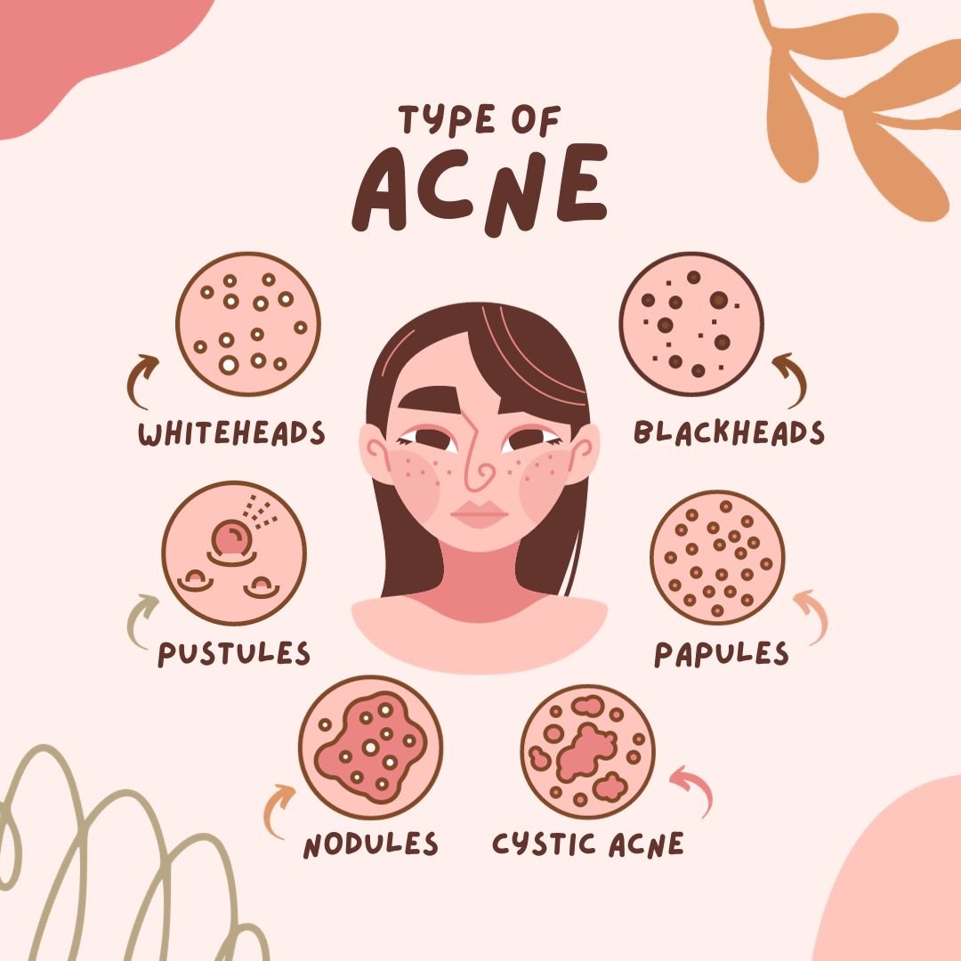 PCOS Acne Blog Image - Identifying Acne Types with insights from Dr. Shabnam Sharjil at PCOS Ferticure Clinic for personalized PCOS-PCOD management.